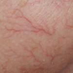 threadveins