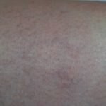 Leg veins after 1 session