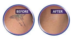 Laser Tattoo Removal 2
